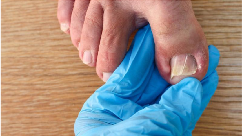 Onychomycosis Topical Treatment with Causes and Prevention