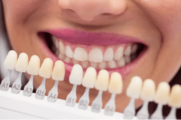 Porcelain Veneers: Transforming Smiles, Enhancing Confidence