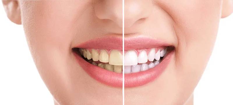 tucson teeth whitening