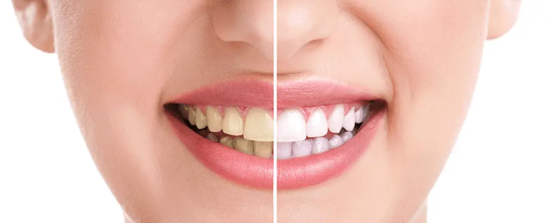 tucson teeth whitening 