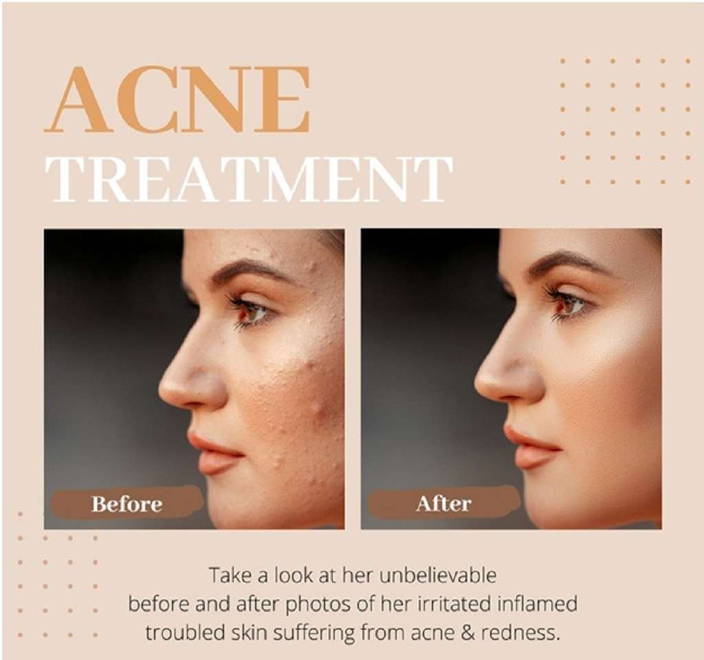 Clear Skin Naturally