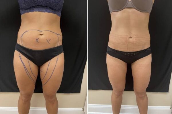 laser liposuction