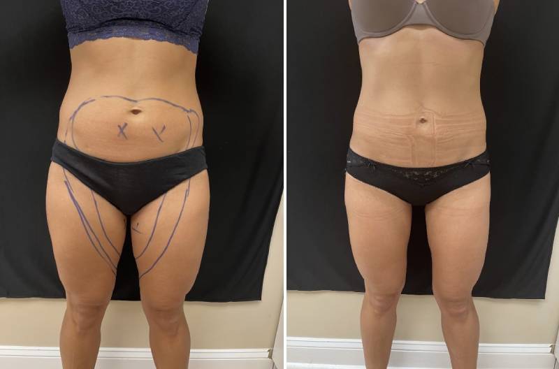 laser liposuction