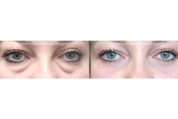 Natural Looking Result with Eyelid Surgery in London eyelid surgery london