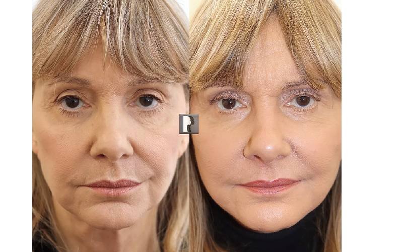 neck lift surgery london