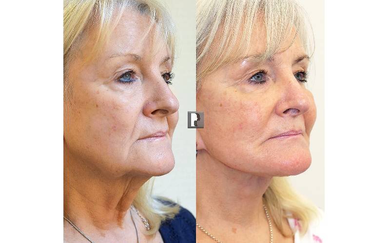 neck lift surgery london