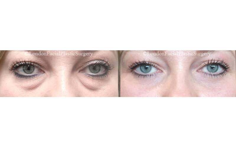 london eyelid surgery