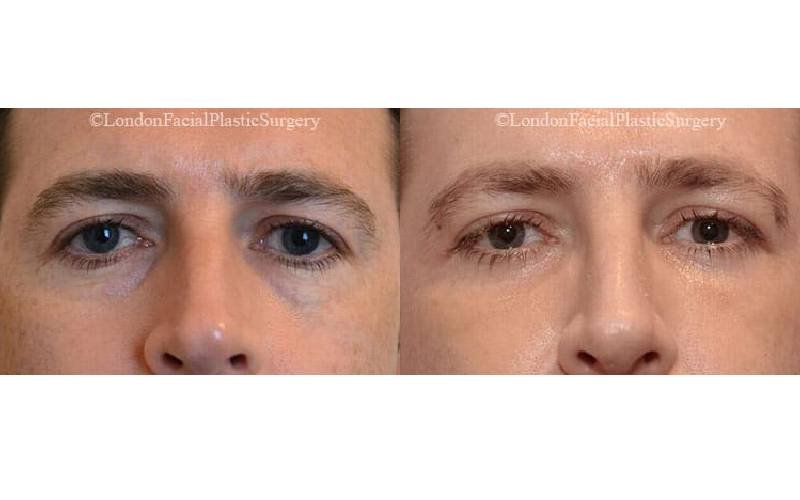 london eyelid surgery