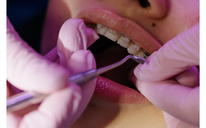 Dental Fillings in Houston
