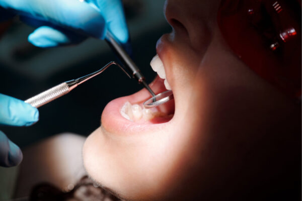 Dental Fillings in Houston