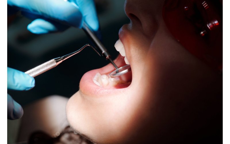 Dental Fillings in Houston