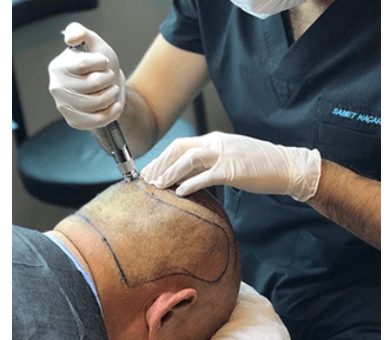 Dhi Hair Transplant In Istanbul