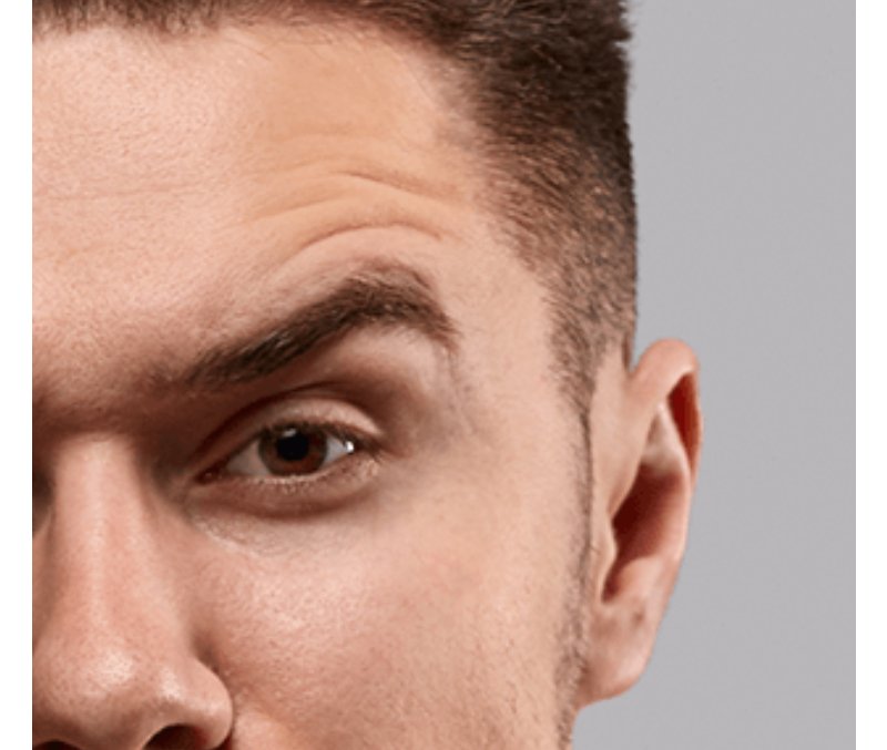 Dhi Hair Transplant In Istanbul