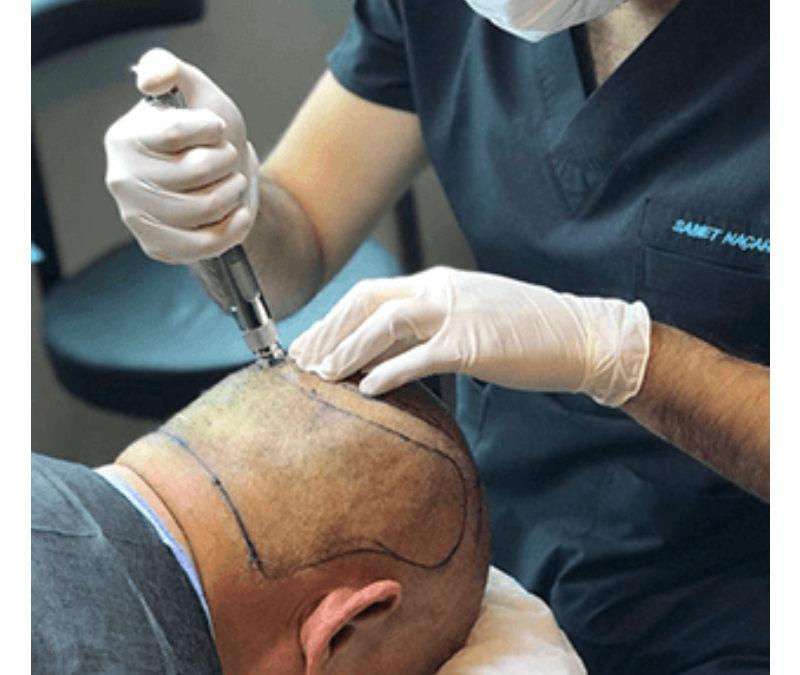 Hair Transplants in Turkey