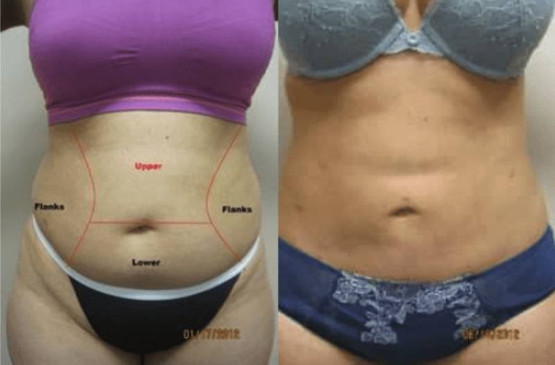 laser lipo dc