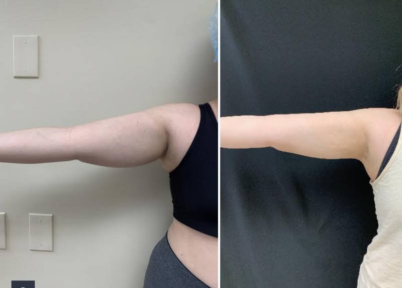 laser lipo dc