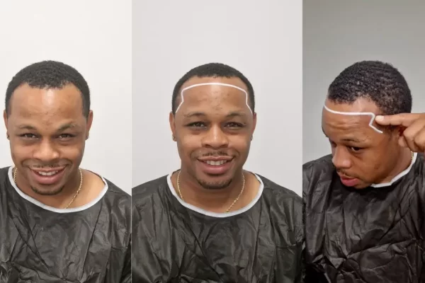 Hair Transplants