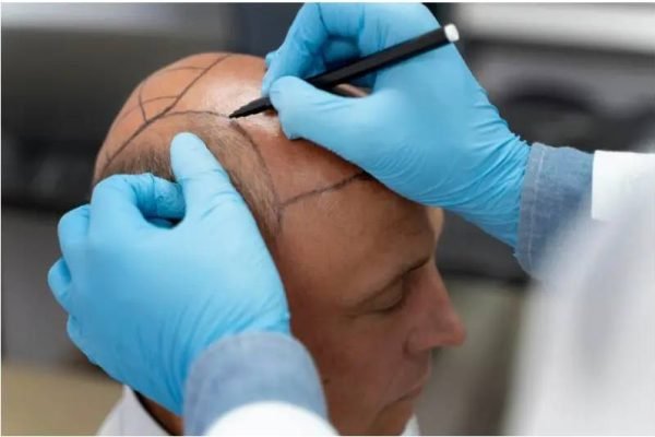 FUE Hair Transplant