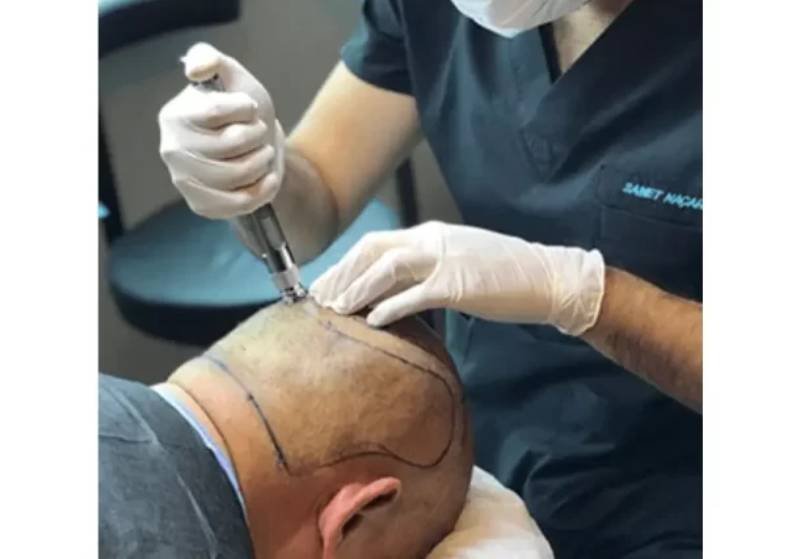 FUE Hair Transplant In Istanbul?