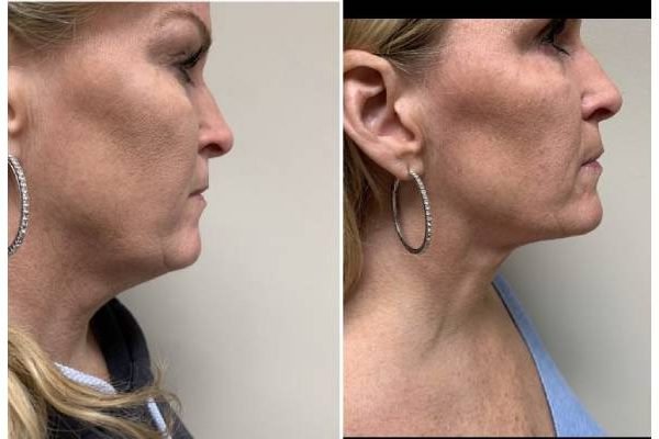 Laser Lipo In Washington DC: Your Partner In Achieving Your Dream Body