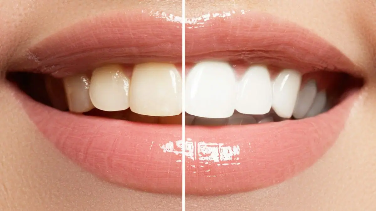 Crest Teeth Whitening