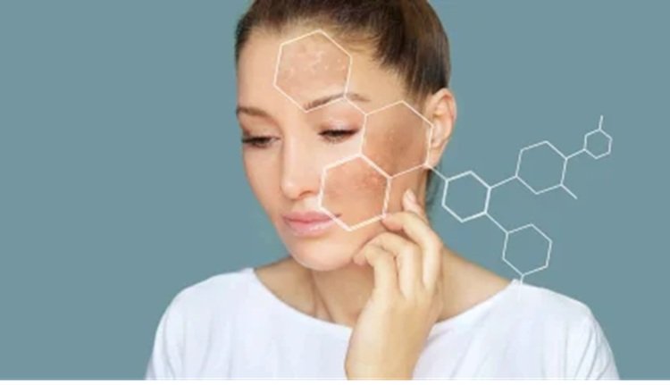Skin Pigmentation Treatment