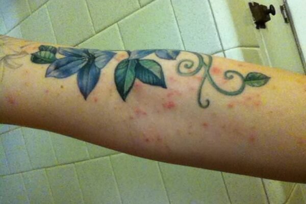 Tattoo Allergies