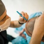 DHI Hair Transplantation: A comprehensive guide to modern day hair implantation