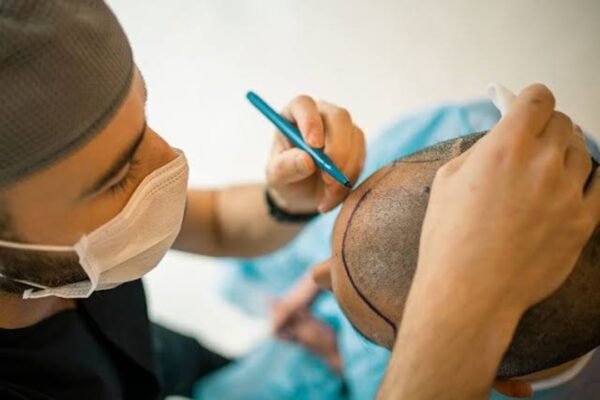 DHI Hair Transplantation: A comprehensive guide to modern day hair implantation DHI Hair Transplantation