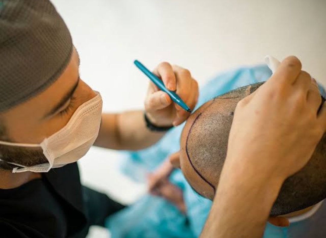 DHI Hair Transplantation