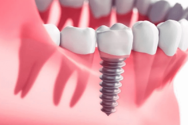 Why Dental Implants Are the Ultimate Solution for Missing Teeth