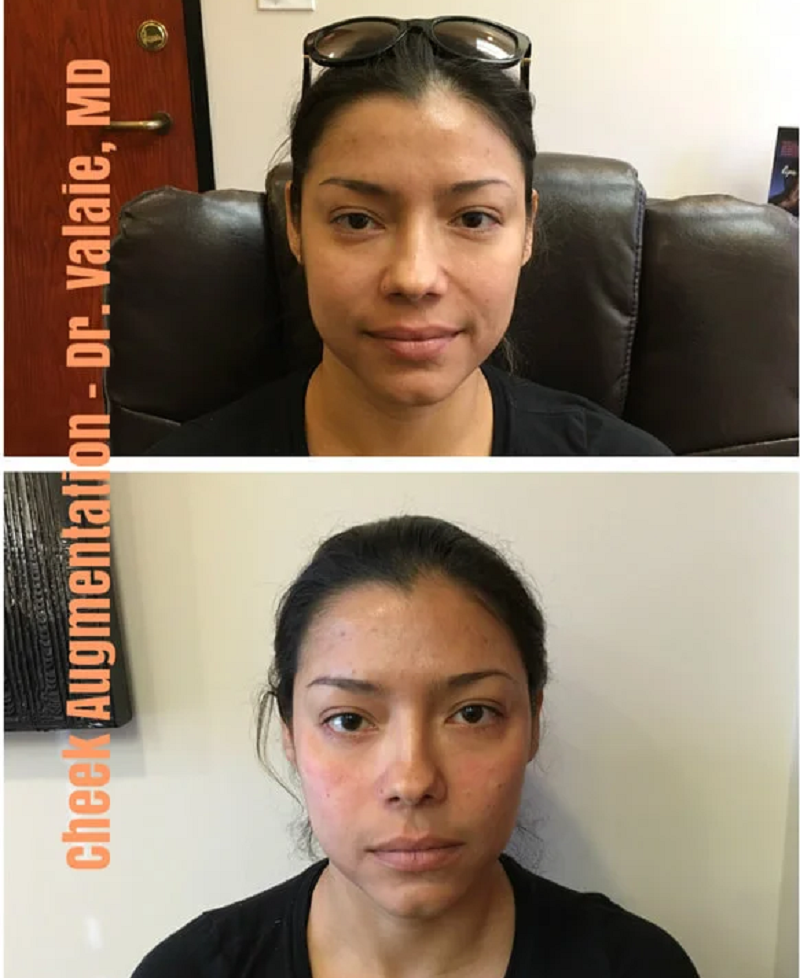 Choose the Right Cheek Enhancement Procedure for Your Face Shape