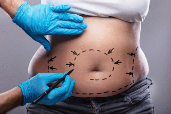 Tumescent Liposuction