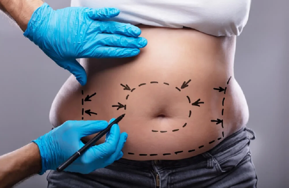 Tumescent Liposuction