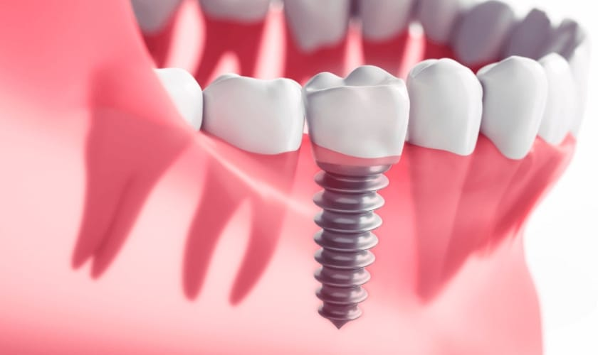 Why Dental Implants Are the Ultimate Solution for Missing Teeth?