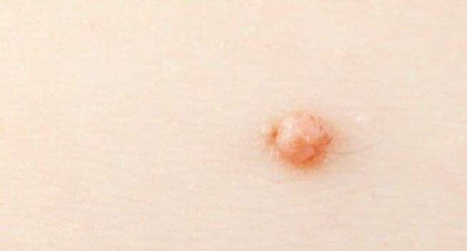 What Are the Causes of Genital Wart Removal? Treatment, Symptoms 