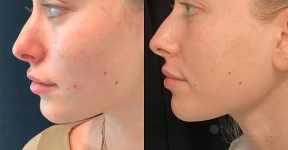 Discover the ‘PRP Treatment for Face’