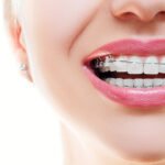 Smart Steps Experts Use to Create Perfect Smiles