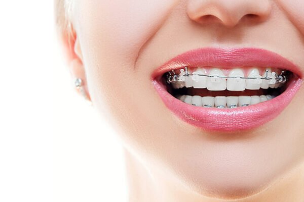 adult braces before and after