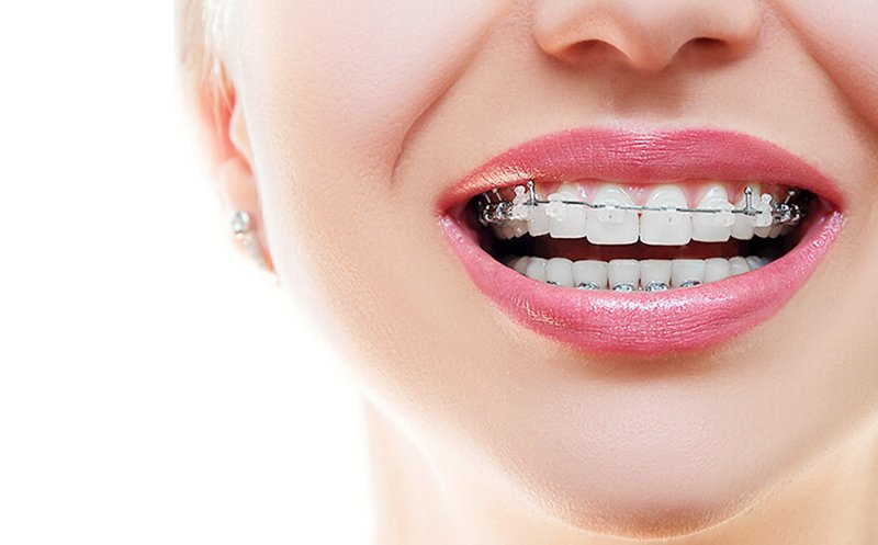 adult braces before and after