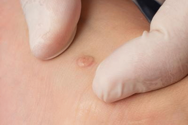 Do Over-the-Counter Wart Treatments Really Work? Do Over-the-Counter Wart Treatments Really Work?