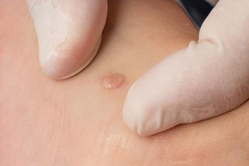Do Over-the-Counter Wart Treatments Really Work?
