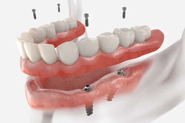 Close-up of implant supported dentures showing stability and natural look.