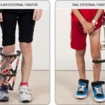 Advancements In Limb Lengthening Techniques: What’s New In Orthopedic Care?