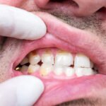 3 Habits That Can Undermine The Results Of Dental Restorations