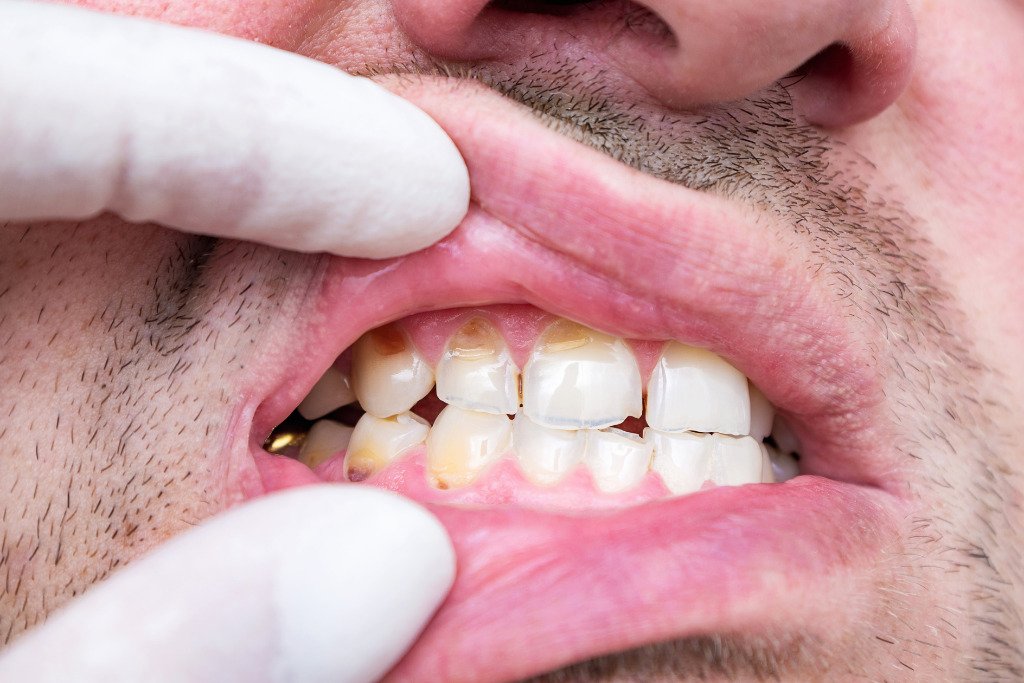 Common habits that damage dental restorations