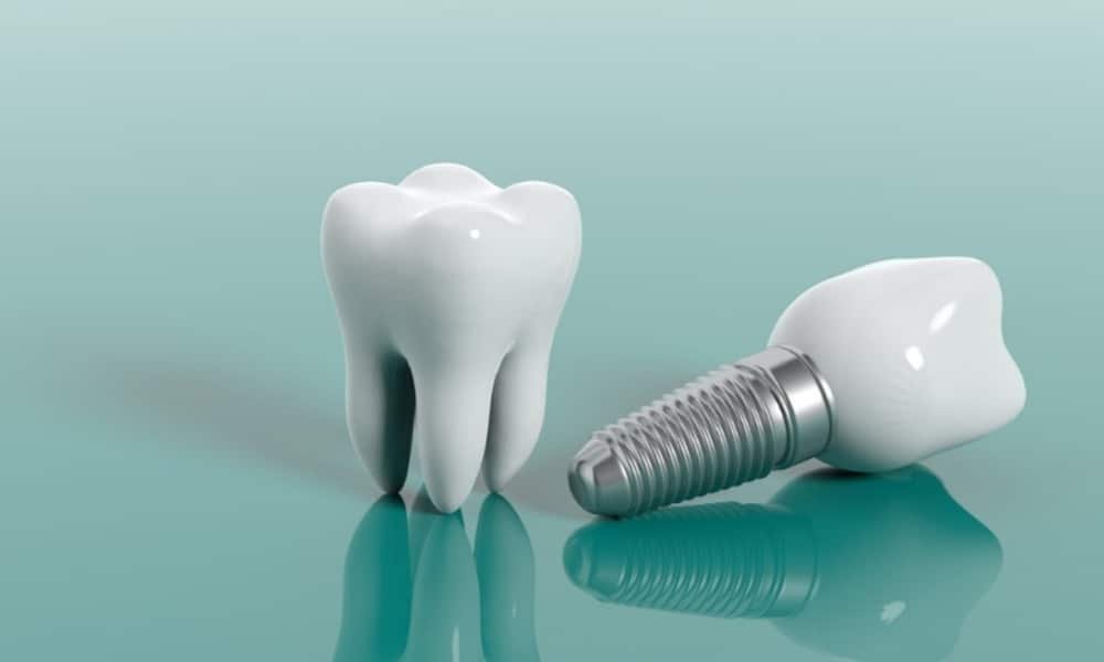Dental Implants