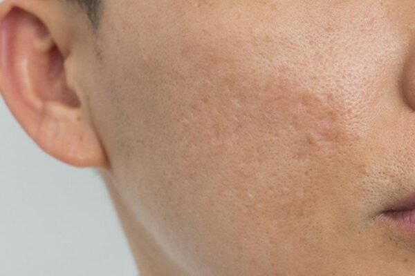 3 Types of acne scars and their treatments