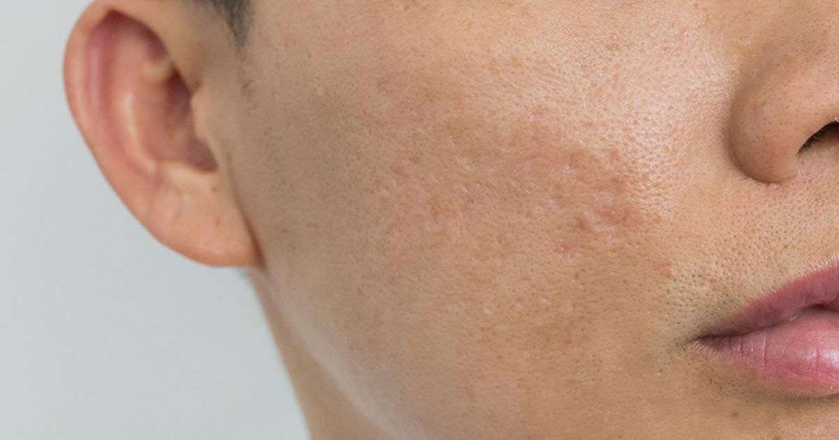 3 Types of acne scars and their treatments
