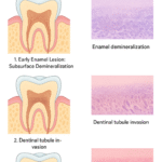 Histological Changes in Dental Caries: What Happens Inside a Decaying Tooth